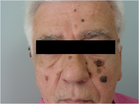 Skin cancers of the face and pigmented keratoses - after a year